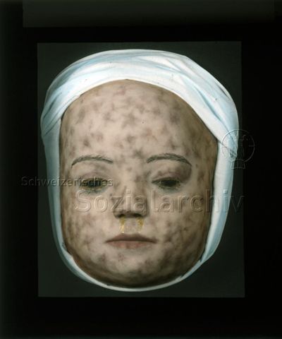 Diaserie zum Thema Kinderkrankheiten; Modell eines Kindergesichts mit Hautentzündungen, verklebten Augen und laufender Nase; um 1930