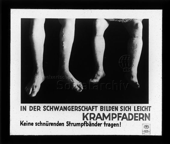 Diaserie zum Thema Schwangerschaft; "In der Schwangerschaft bilden sich leicht Krampfadern - Keine schürenden Trumpfbänder tragen! - Deutsches Hygiene-Museum Dresden" - Fotografie: Frauenbeine mit Krampfadern; um 1930