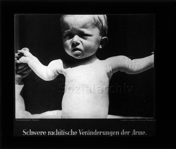 Diaserie zum Thema Säuglingspflege; "Schwere rachistische Veränderungen der Arme." - "Deutsches Hygiene-Museum, Dresden"; Kleinkind mit verformten Armen; um 1930