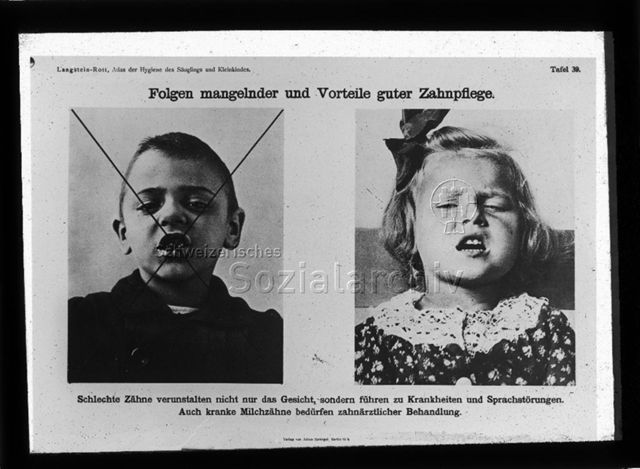 Diaserie zum Thema Säuglingspflege; "Folgen mangelnder und Vorteile guter Zahnpflege. - Schlechte Zähne verunstalten nicht nur das Gesicht, sondern führen zu Krankheiten und Sprachstörungen. Auch kranke Milchzähne bedürfen zahnärztlicher Behandlung." - Porträt eines Jungen mit schlechten Zähnen und eines Mädchens mit gesunden Zähnen; "Langstein-Rott, Atlas der Hygiene des Säuglings und Kleinkindes"; um 1920