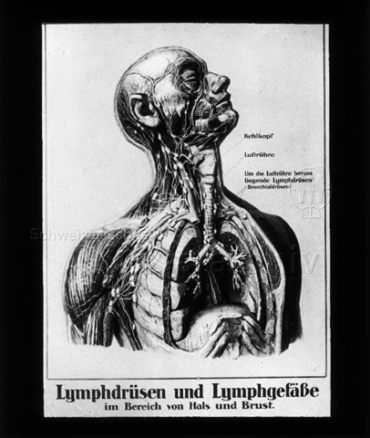 Diaserie zum Thema Tuberkulose im Kindesalter; "Lymphdrüsen und Lymphgefässe im Bereich von Hals und Brust." - anatomische Zeichung; Deutsches Hygiene-Museum; um 1930