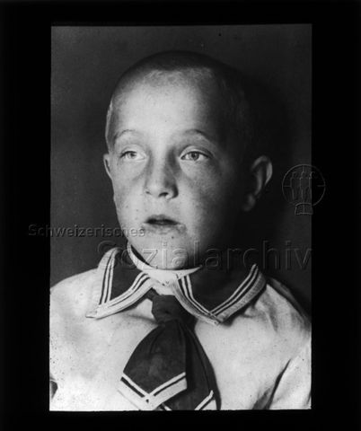 Diaserie zum Thema Tuberkulose im Kindesalter; Mund-Atmer; Knabe mit geöffnetem Mund und Rötungen um Mund;  Deutsches Hygiene-Museum; um 1930
