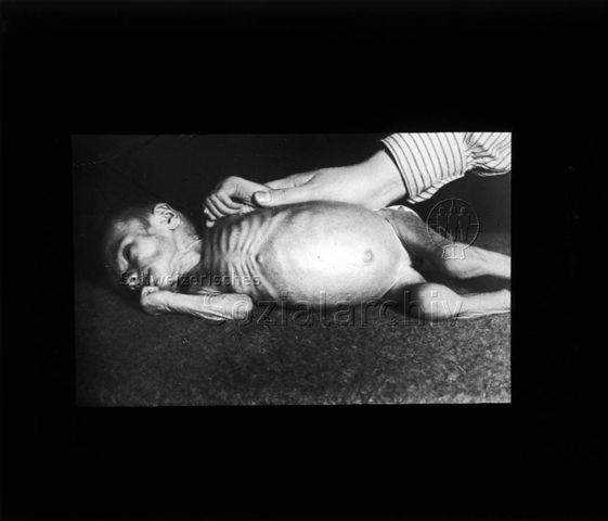 Diaserie zum Thema Säuglingspflege; Durch Flaschenernährung heruntergekommenes Kind - unterernährtes Kind auf der Seite liegend; Deutsches Hygiene-Museum, Dresden; um 1930