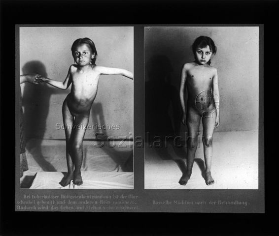 Diaserie zum Thema Tuberkulose im Kindesalter; Bei tuberkulöser Hüftgelenkentzündung ist der Oberschenkel gebeugt und dem anderen Bein genähert. Dadurch wird das Gehen und Stehen sehr erschwert.- Dasselbe Mädchen nach der Behandlung" - Fotografien eines Mädchen vor und nach der Behandlung; Deutsches Hygiene-Museum; um 1930