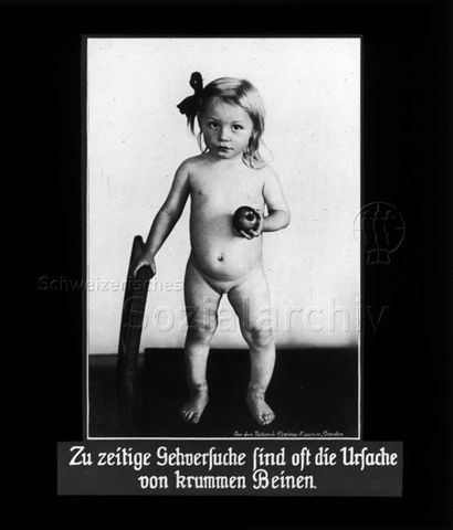 Diaserie zum Thema Säuglingspflege; "Zu zeitige Gehversuche sind oft die Ursache von krummen Beinen"; nacktes Mädchen mit krummen Beinen und Apfel in der Hand; um 1930