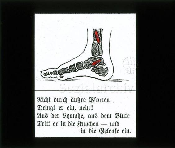 Diaserie zum Thema Kinderkrankheiten, Bazillen, Tuberkulose; "Nicht durch äussere Pforten dringt er ein, nein! Aus der Lymphe, aus dem Blute Tritt er in die Knochen - und in die Gelenke ein." - Zeichnung: Fussknochen mit roten Strichmännchen (Bazillen); um 1930