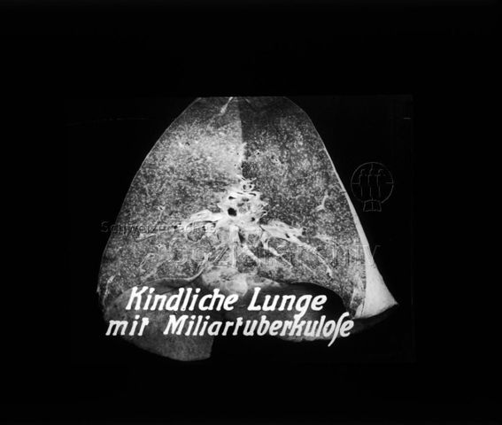 Diaserie zum Thema Tuberkulose im Kindesalter; "Deutsches Hygiene-Museum" - Röntgenbild einer befallenen Lunge; Deutsches Hygiene-Museum; um 1930