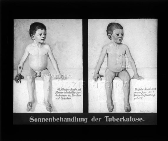 Diaserie zum Thema Tuberkulose im Kindesalter; "Sonnenbehandlung der Tuberkulose." - Zeichnungen: "4 1/2 jähriger Knabe mit schweren tuberkulösen Veränderungen an Knochen und Gelenken" und "Derselbe Knabe nach einem Jahr durch Sonnenbestrahlung gheilt."; Deutsches Hygiene-Museum; um 1930
