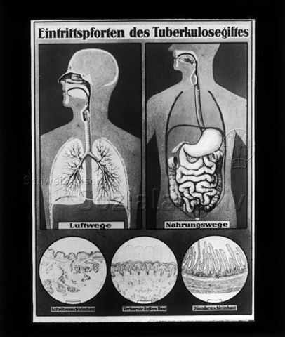 Diaserie zum Thema Tuberkulose im Kindesalter; "Eintrittspforten des Tuberkulosegiftes." - Zeichnungen: Oberkörper und Kopf einer Person mit eingezeichneten "Luftwegen" und "Nahrungswegen" und schematische Zeichnungen der "Luftröhrenschleimhaut", "Verhornte äussere Haut" und "Dünndarmschleimhaut"; Deutsches Hygiene-Museum; um 1930
