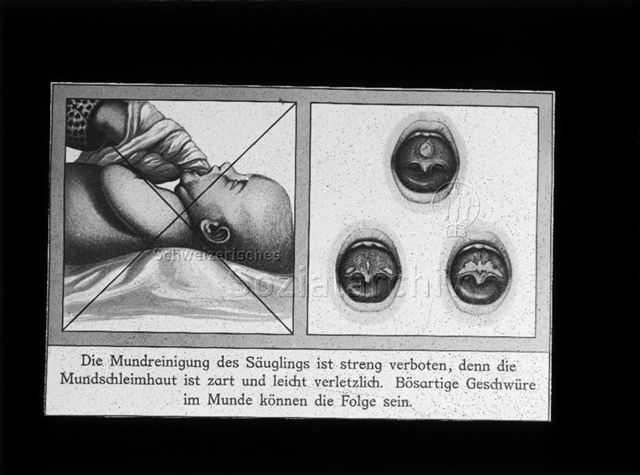 Diaserie zum Thema Säuglingspflege; "Die Mundreinigung des Säuglings ist streng verboten, denn die Mundschleimhaut ist zart und leicht verletzlich. Bösartige Geschwüre im Munde können die Folge sein." - links: Person mit Lappen um Finger am Reinigen des Munds eines Säuglings; mit Kreuz durchgestrichen; rechts: Illustration von Geschwüren im Mund eines Säuglings; um 1930