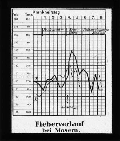 Diaserie zum Thema Kinderkrankheiten; "Fieberverlauf bei Masern." - grafische Darstellung während einer Zeitspanne von acht Tagen; um 1930