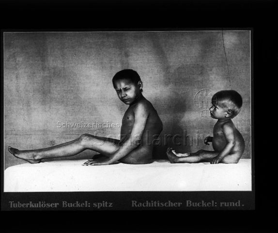 Diaserie zum Thema Tuberkulose im Kindesalter; "Tuberkulöser Buckel: spitz - Rachitischer Buckel: rund." - zwei Jungen mit deformierten Rücken; Deutsches Hygiene-Museum; um 1930