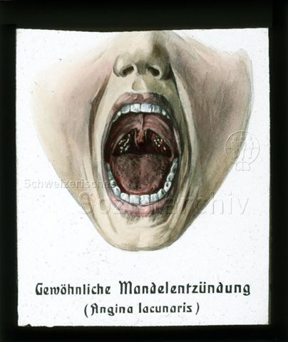 Diaserie zum Thema Kinderkrankheiten; "Gewöhnliche Mandelentzündung (Angina lacunaris)" - Zeichnung: geöffneter Munde mit roter Zunge und Ablagerungen im Rachen; um 1930