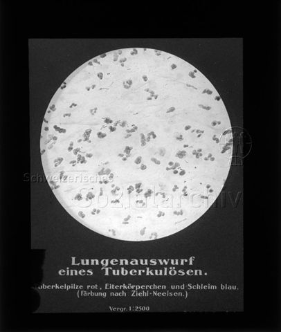Diaserie zum Thema Tuberkulose im Kindesalter; "Lungenauswurf eines Tuberkulösen." - Deutsches Hygiene-Museum; um 1930