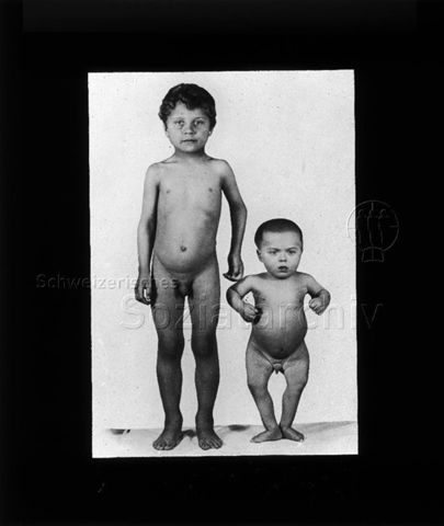 Diaserie zum Thema Kinderkrankheiten; gesunder Junge neben einem Jungen mit rachistischen Merkmalen (deformierte Beine und Arme und geringere Körpergrösse) stehend; um 1930