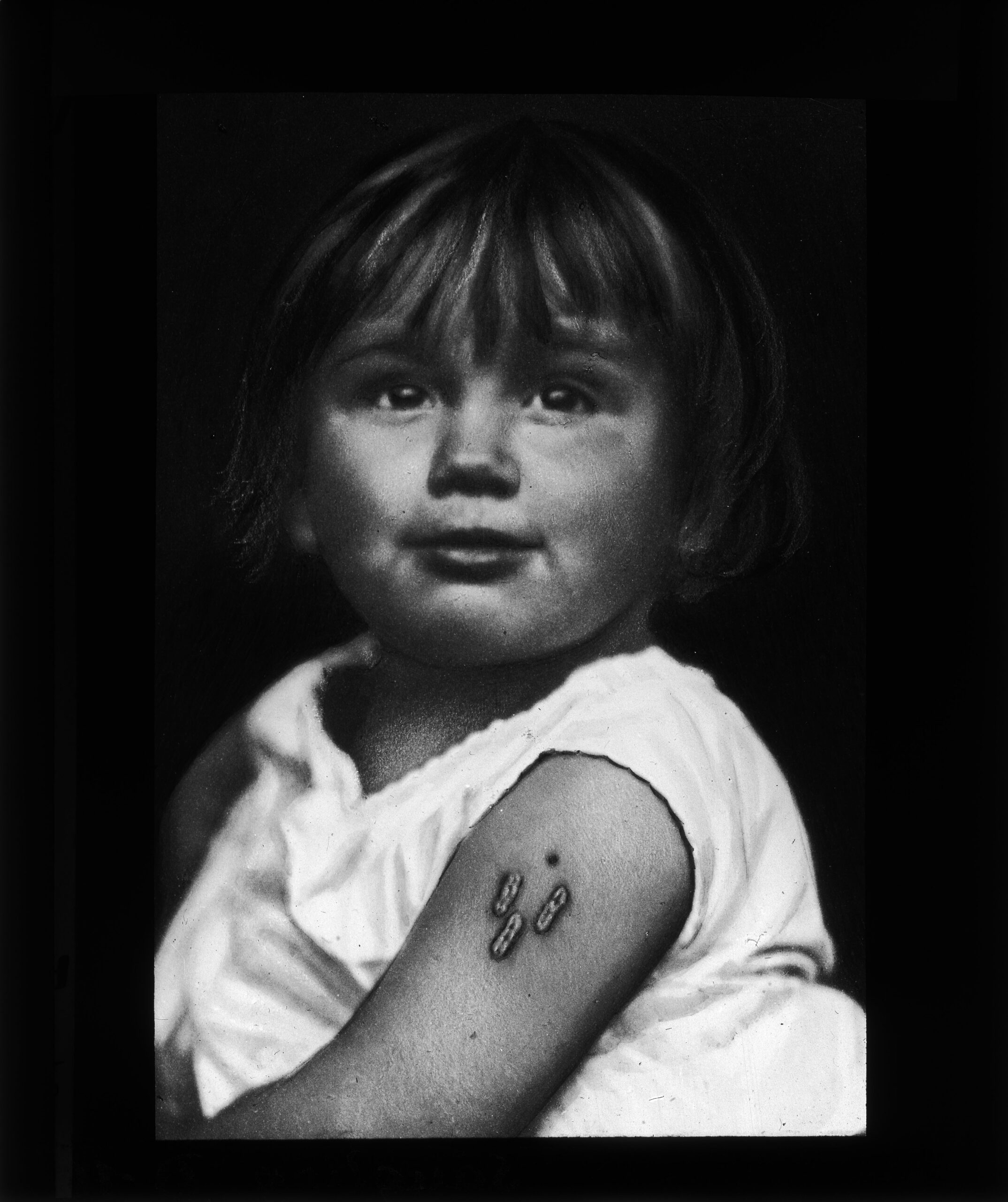 Diaserie zum Thema Kinderkrankheiten; Mädchen mit Impfpocken am Oberarm; um 1930