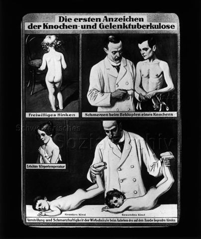 Diaserie zum Thema Tuberkulose im Kindesalter; "Die ersten Anzeichen der Knochen- und Gelenktuberkulose" - Zeichnungen: Kinder, die Symptome zeigen; "Freiwilliges Hinken", "Schmerzen beim Beklopfen eines Knochens", "Erhöhte Körpertemperatur", "Versteifung und Schmerzhaftigkeit der Wirbelsäule beim Anheben des auf dem Bauche liegenden Kindes"; Deutsches Hygiene-Museum; um 1930